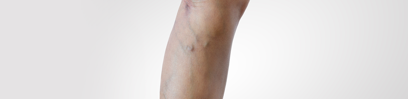 해피비뇨기과 하지정맥류 치료