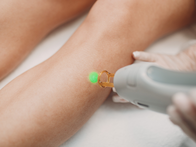 레이저 수술 요법